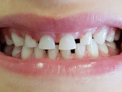 MACCHIE SCURE SUI DENTI CAUSATE DAI BATTERI CROMOGENI