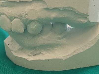 Modelli dentali in gesso