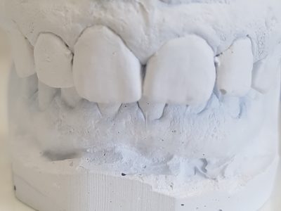 Modelli dentali in gesso