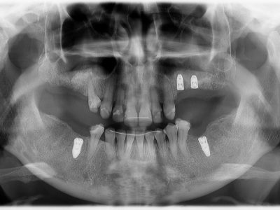Lastra panoramica dopo la terapia (rialzo del seno mascellare con implantologia)