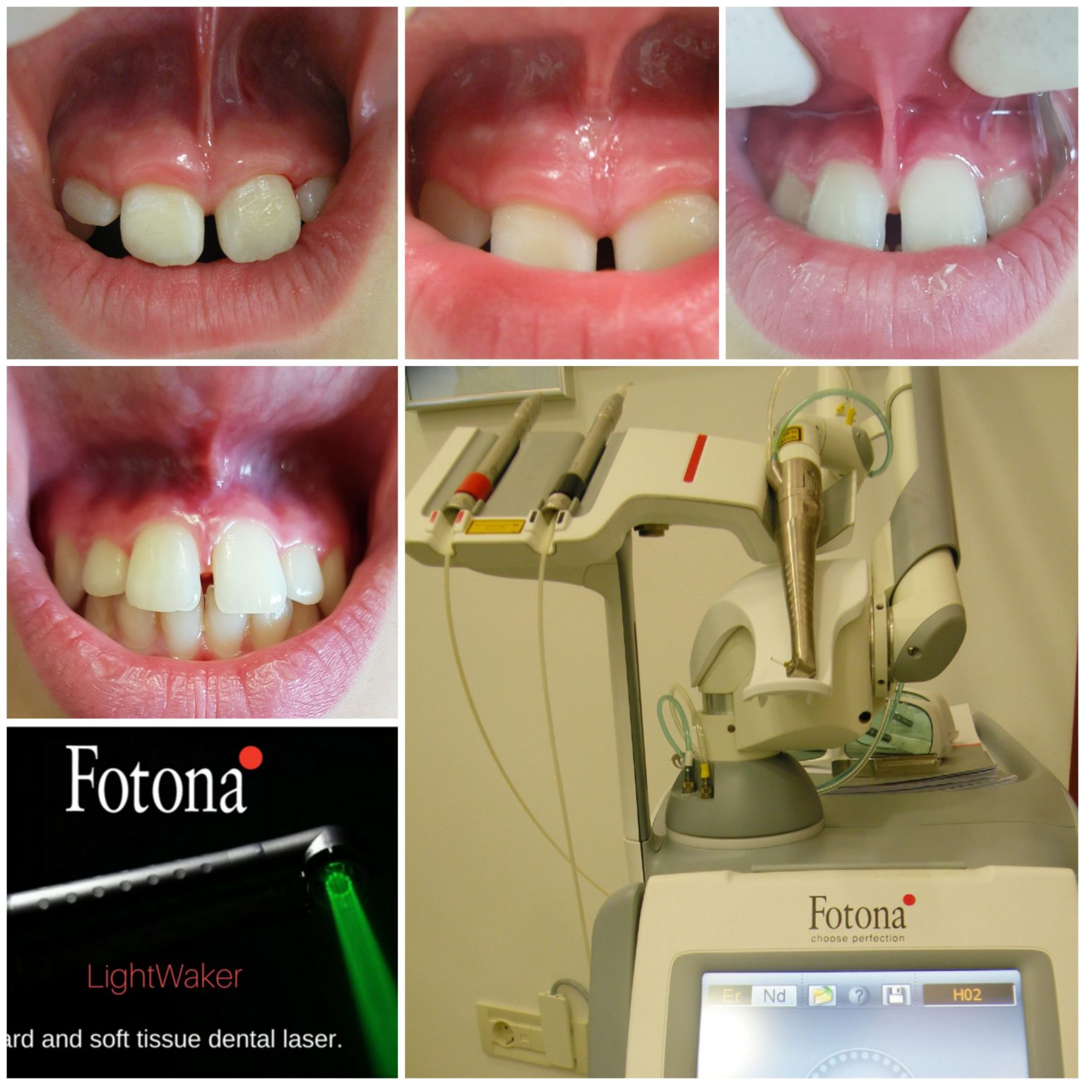 FRENECTOMY WITH ERBIUM LASER Studio Stradiot
